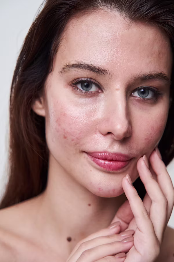 ANTI-ACNE